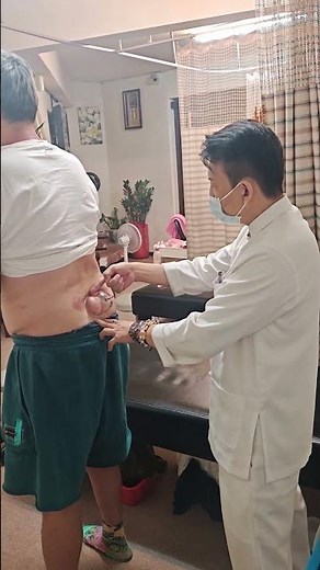脊椎側彎的原理以及富貴包的由來