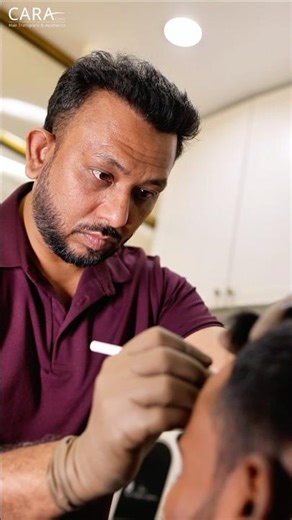 How Precision Marking Changes Your Hair Transplant Outcome #hairtransplant #trending