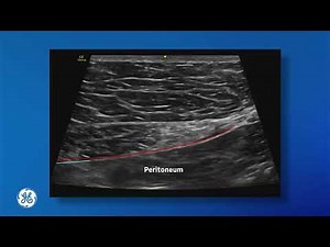 Venue Family | Rectus Sheath Block