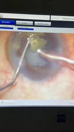👁 عملية إزالة الماء الأبيض: رحلة قصيرة نحو رؤية واضحة وكاملة ✨
