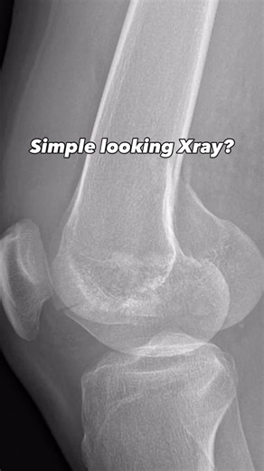 Just Ortho Things on Instagram: "In Distal Femur, radiographs often overshadow the extent of condylar injury especially when one condyle is majorly affected. CT tells the story. Share a case with lateral condyle > medial condyle coronal shear injury with follow up. . . . . . . . . #justorthothings #trauma #ortho #fracture #bone #surgery #orthoworld #instaortho #doctor #femur #hip #knee #injury #skills #learning #cases #journals #beyond #textbooks #medical #education #orthopedics"