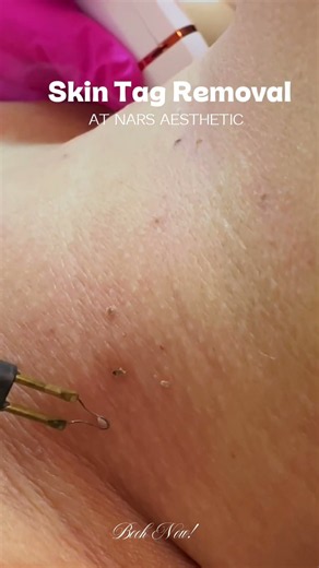 A quick and precise procedure to remove unwanted skin tags and achieve smoother-looking skin.
