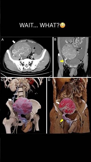 Retroperitoneal Mass CT Scan Hidden Clue Explained #shorts