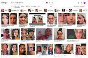 Topical Steroid Withdrawal - Everything We Know So Far | TSW Assist