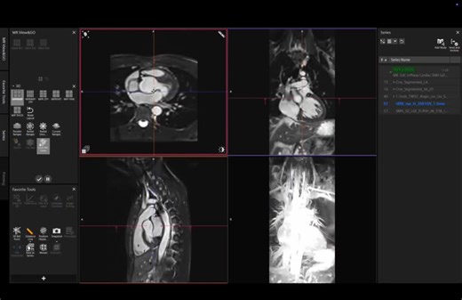 #cmr #scmr #mri #siemenshealthineers #philipsmri #cardiacmri #radiologyprofessionals #1point5tesla #radiologyrounds #cardiology #radiology #gemri #training #eacvi #innovation #imageoptimization… | Stephen Mhiribidi