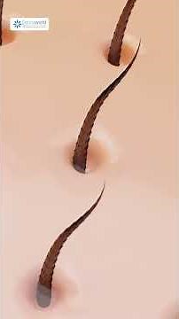 Causes of hair dandruff | Causes Tips and Solutions for Healthy Scalp