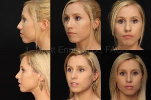 Rhinoplasty Surgery in Boca Raton with Top Rated Surgeon Dr. Ennis