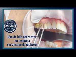 Uso de hilo retractor en lesiones cervicales de molares
