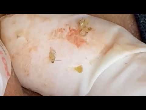 Watch These Giant Blackheads Get Popped!