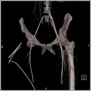 Cardiac: Type A Dissection (1 of 3)