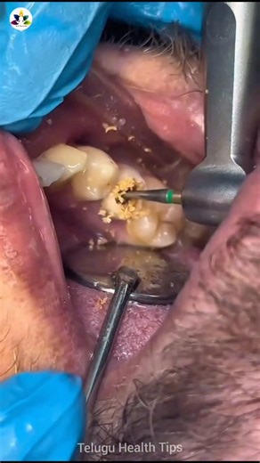 Health_Tips_Kannada on Instagram: "ನಿಮ್ಮ ಹಲ್ಲುಗಳಲ್ಲಿ ಹುಳುಗಳಿವೆಯೇ? ನಿಮ್ಮ ಬಾಯಿಯಿಂದ ದುರ್ವಾಸನೆ ಬರುತ್ತಿದೆಯೇ? ನಿಮ್ಮ ಹಲ್ಲುಗಳು ಹಳದಿಯಾಗಿವೆಯೇ? . . “Disclaimer: The tips and advice provided in this post are intended for general wellness information only. They should not be considered medical advice, diagnosis, or treatment. Always consult a qualified doctor or healthcare professional before taking any action.” . . #kannada #bangalore #teethcare #healthylifestyle #reels"