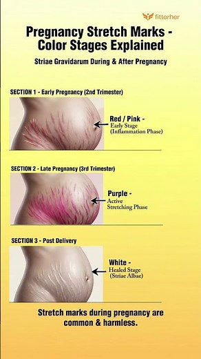 Pregnancy Stretch Marks – What Do the Colors Mean? 🤰🏻