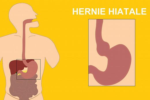 Hernie hiatale : symptômes, âge, cause, quand opérer ?
