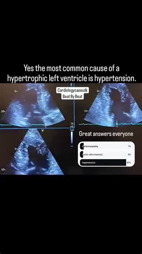 Hypertension: Leading Cause of Left Ventricle Hypertrophy