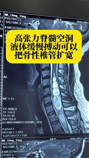 高张力脊髓空洞液体缓慢搏动可以把骨性椎管扩宽 #脊髓空洞 #脊髓空洞症 #小脑扁桃体下疝 #手麻 #肌肉萎缩