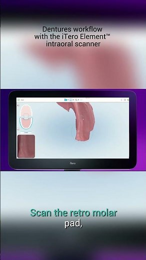 How to scan the edentulous mandible efficiently | iTero™ intraoral scanner training #dentist