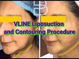 VLINE Liposuction and Contouring Procedure By Doc BIEN PO