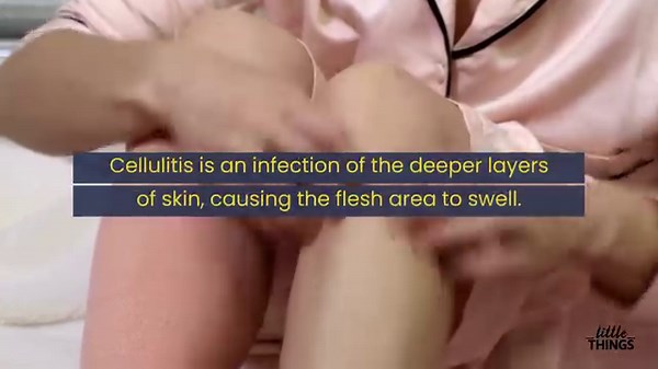 2K views | MRSA is a superbug that causes swelling and irritation of the skin. It's a bacteria that resists most of the antibiotics out there. Here's what you need to know. #health #healthtip Read more>> bit.ly/3V3gdro | Purple Clover | Facebook