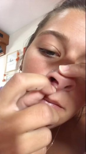 pimplepopping.tv on Instagram: "…… just pop it !! . . . : #pimple #pimplepopping #pores #pimplepop #pimples #acne #blackheads #whiteheads #blackheads #blackheadremover #blackhead"