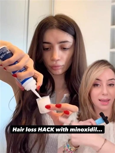 Hair Loss Hack with Topical Minoxidil