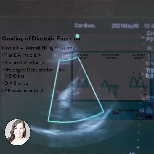 🩺Grade 1 Diastolic Dysfunction on Echo Explained 💓