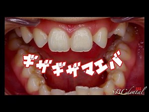 ギザギザな前歯を綺麗に（１日で綺麗になるセラミック治療：仮歯）