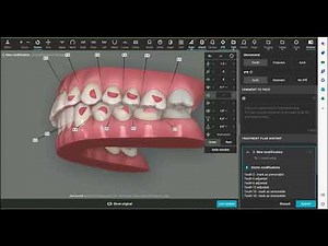 3D Controls: How to Shorten an Invisalign® Treatment Plan