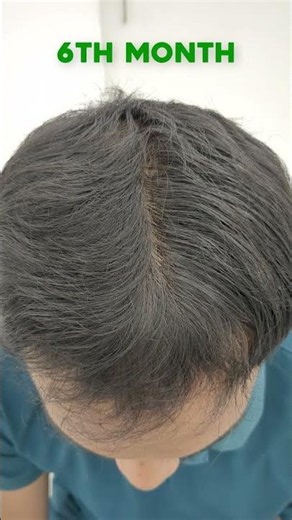 GFC Hair Treatment Results 😳 Massive Hair Regrowth! 🔥