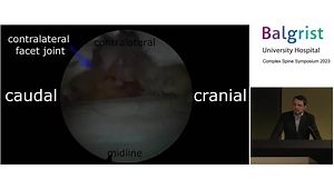 Interlaminar Endoscopic Approach