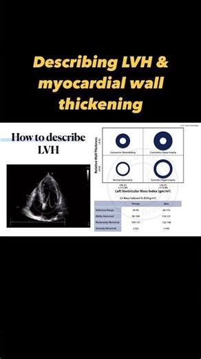 Describing hypertrophy in #echocardiography #ultrasound #hypertension #hypertrophy