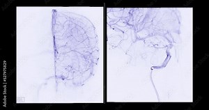 Cerebral angiogram for diagnosis abnormalities such as cerebral artery aneurysms and cerebral artery disease such as atherosclerosis (plaque). Stock Video