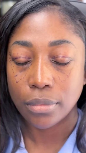 Before & After: Dark Circles, Heavy Eye Bags & Hooded Eyelids