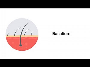 Basaliom (Hautkrebs) - Erkrankungen der Haut