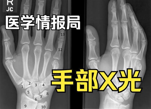【医学情报局】手部X光 Hand Xray