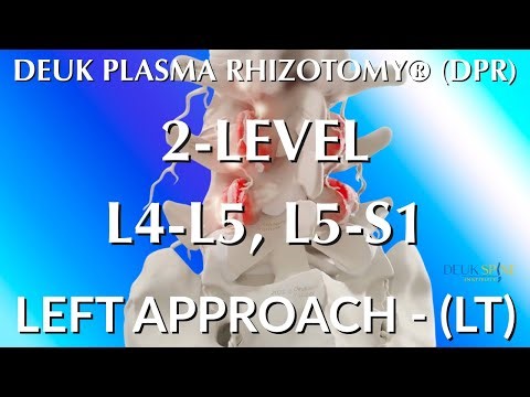 RHIZOTOMY for LOWER BACK PAIN - L4-L5, L5-S1
