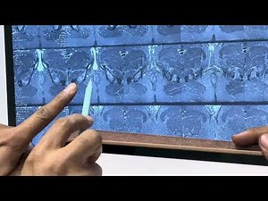 Ischioanal Fossa Anatomy Explained | Part 1 | Fistula & Abscess Important Area | Dr. Sanjeet Sahu