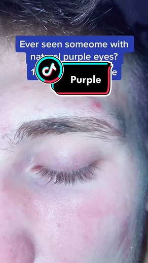 Purple Eyes: Rare Eye Colors and Their Rarity