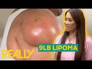 Dr. Lee Helps Remove HUGE 9LB Lipoma From Man's Shoulder I Dr. Pimple Popper