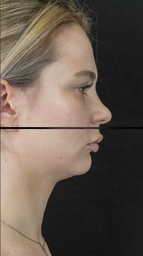 Short face and mandible retrusion