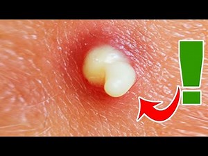 5 ways to treat and remove pimples from your face.