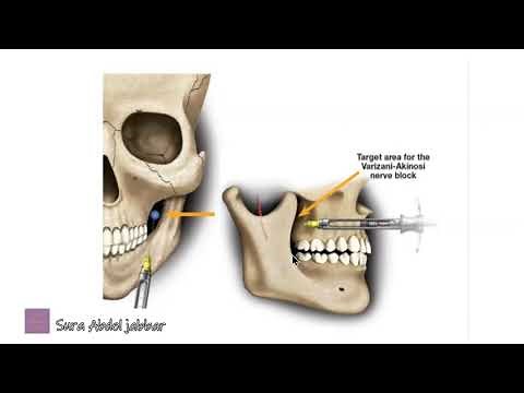 Vazirani-Akinosi Nerve Block Technique