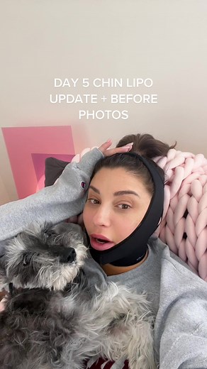Chin Lipo Day 5 Update: Healing Journey Insights