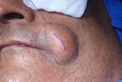 Epidermal Inclusion Cyst Incision and Drainage