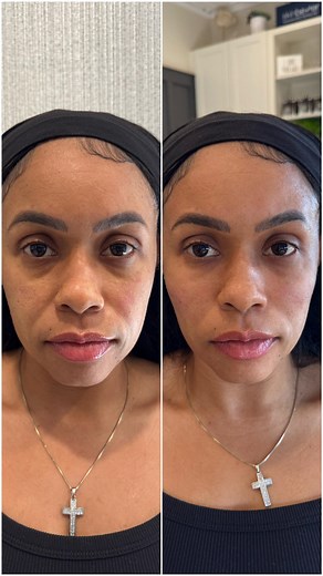 Nicole Smith | California | Botox, Filler, Anti-aging | Fix your jowls with Botox! If you have lower face or jawline sagging try these 3 Botox injections. This trio will give you a nice... | Instagram