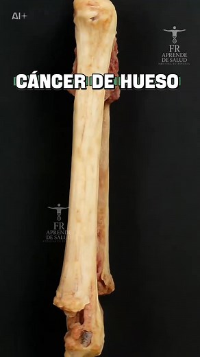El cáncer de hueso ocurre cuando las células del tejido óseo comienzan a multiplicarse sin control, debilitando la estructura del hueso y causando dolor persistente. En medicina se conoce que puede aparecer en cualquier hueso, pero afecta con más frecuencia a piernas, brazos y pelvis. Detectarlo temprano marca la diferencia. Educar es salvar vidas. Comparte este mensaje. #CáncerDeHueso #Oncología #ElCuerpoHumano #BoneCancer #MedicalFacts #Saúde #HumanBody | 𝐴𝑝𝑟𝑒𝑛𝑑𝑒 𝑑𝑒 𝑠𝑎𝑙𝑢𝑑 , 𝑙𝑒�