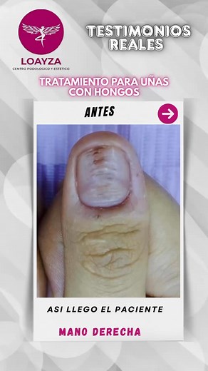 TESTIMONIO REAL – TRATAMIENTO DE HONGOS EN LAS UÑAS 🦠👤 Paciente adulta con micosis moderada localizada en uñas de las manos 📍 Actualmente en su segundo paquete promocional💥 Tratamiento intensivo:✅ Láserterapia combinada✅ Ozono en gas✅ Antimicótico Oleo Forte Ungueal🎯 ¡DILE ADIÓS A LOS HONGOS!Luce tus pies y manos sanos con nuestro tratamiento profesional para onicomicosis (hongos en uñas).🦶💅 Resultados visibles con tecnología avanzada y productos médicos certificados.🔒 ¿Por qué elegirnos