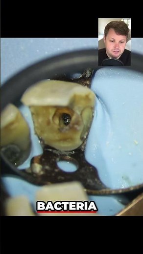 Dentist Explains Why Bioceramic Fillings Are The Best!