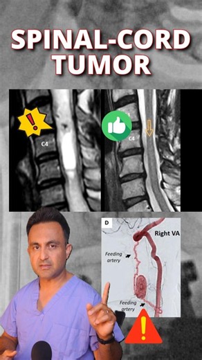 Spinal-cord tumor (hemangioblastoma) #spinalcord