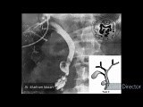 Choledochal Cyst Type II • Video • MEDtube.net