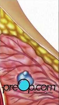 PreOp®👩‍⚕️: Expert Insights on Breast Biopsy Techniques! #preop #shorts #health 💼